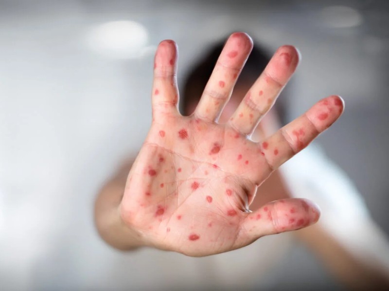 Estados Unidos reporta 1,100 casos de sarampión en 2025