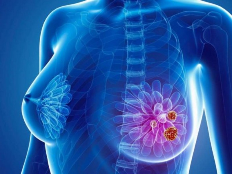 Estudio internacional avala papel de terapia endocrina contra el cáncer
