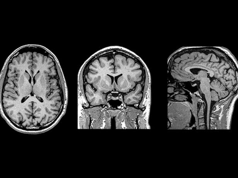 Estudio muestra avances para tratar tumor cerebral de manera efectiva