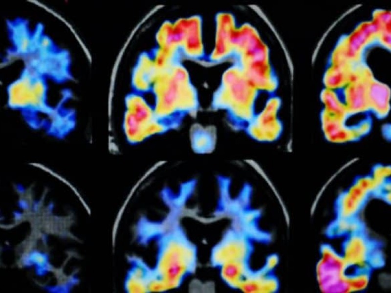 Estudio sobre Alzheimer reunirá datos de 13.000 hispanos y africanos