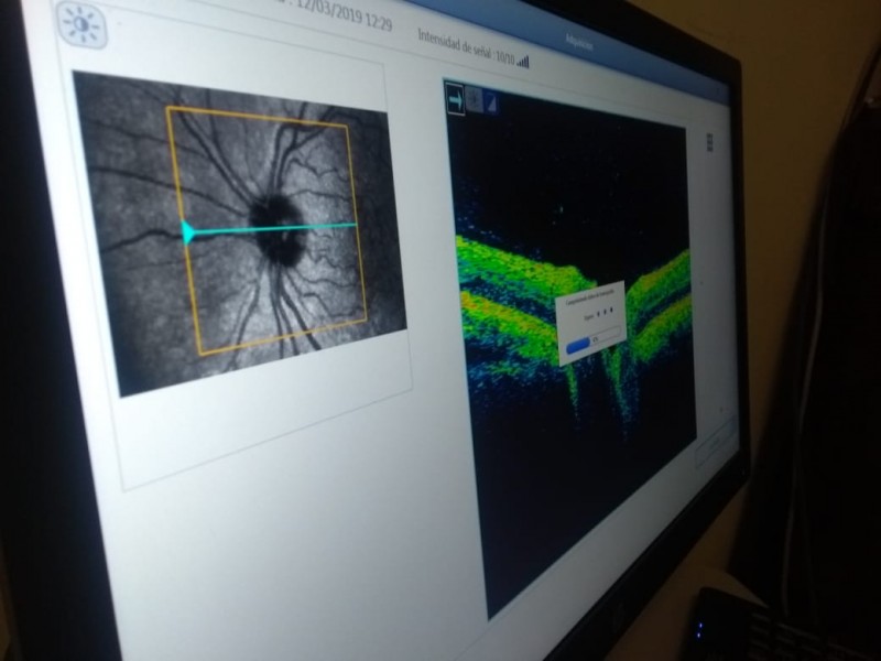 Glaucoma: primer causa de ceguera en México