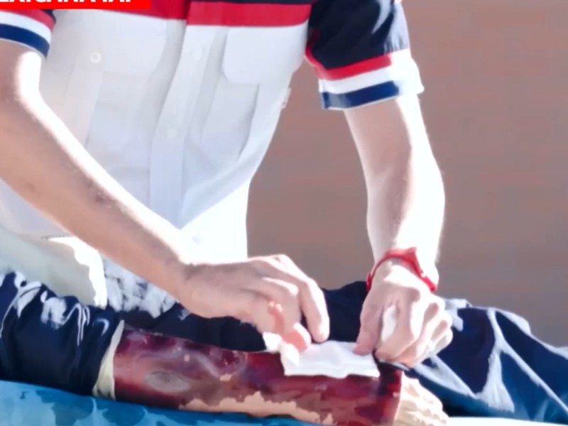 Gravedad de quemaduras y sus complicaciones