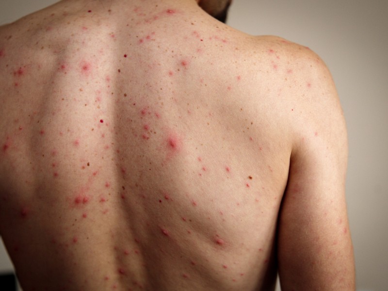 Guerrero cuarto lugar en sarampión con 135 casos