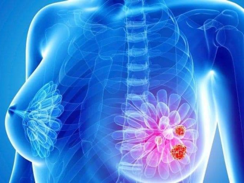 Incrementan casos de cáncer en mujeres mayores: MAM