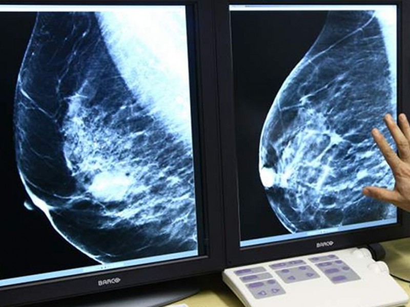 Instalan mastógrafo digital para detectar cáncer de mama