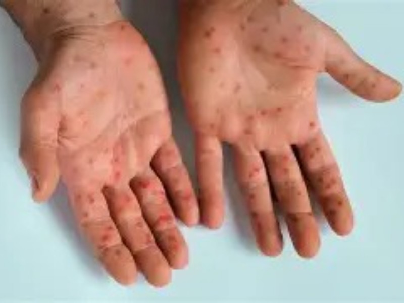 Jalisco suma 54 casos de mpox