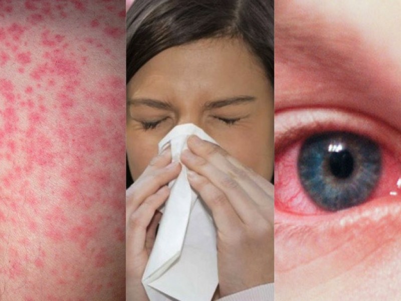 Las alergias podrían llevar a la muerte