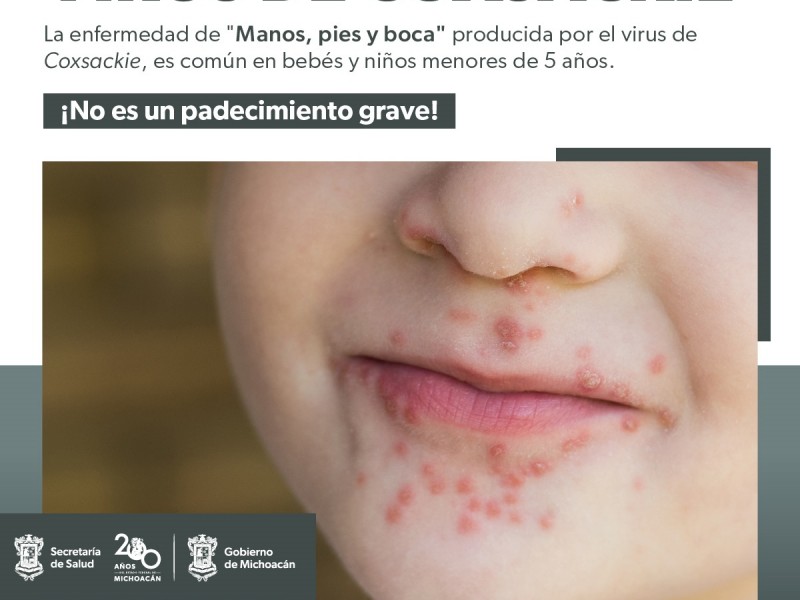 Llaman a prevenir el virus coxsackie