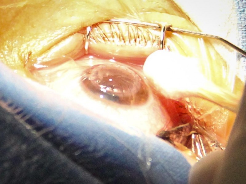 Logra IMSS transplantar 2 córneas