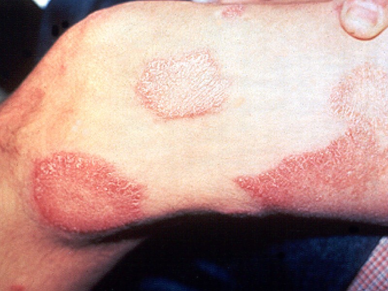 Los casos de lepra aumentan un 10% en el mundo