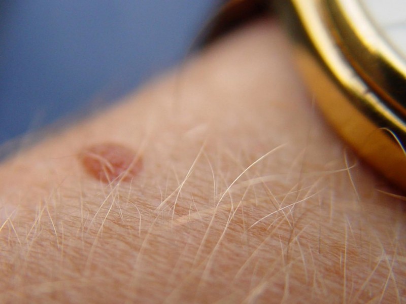 lunares, signos más comunes de cáncer de piel
