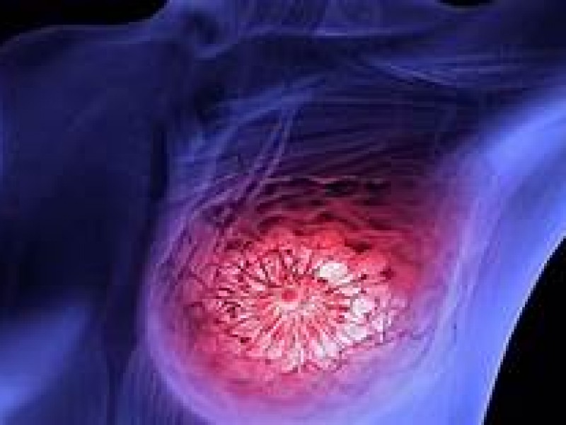 Medellin en 4 lugar de cáncer de mama