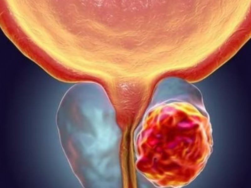 Médicos de América-Latina avanzan contra  tratamientos en cáncer de próstata