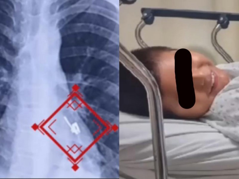 Médicos hallan un zipper en pulmón de un menor