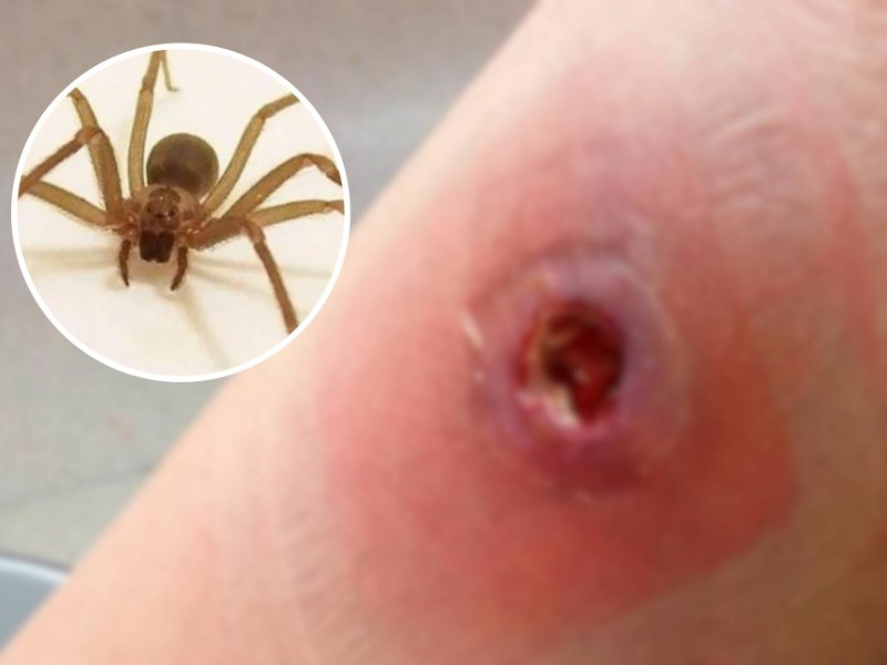 Menor es hospitalizada en Tepic por picadura de araña violinista