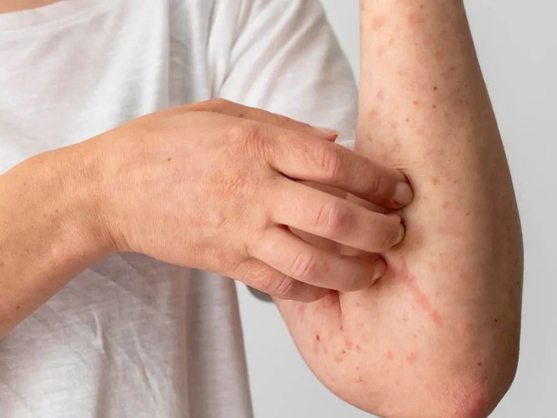 México podría perder su certificación contra el sarampión en 2026