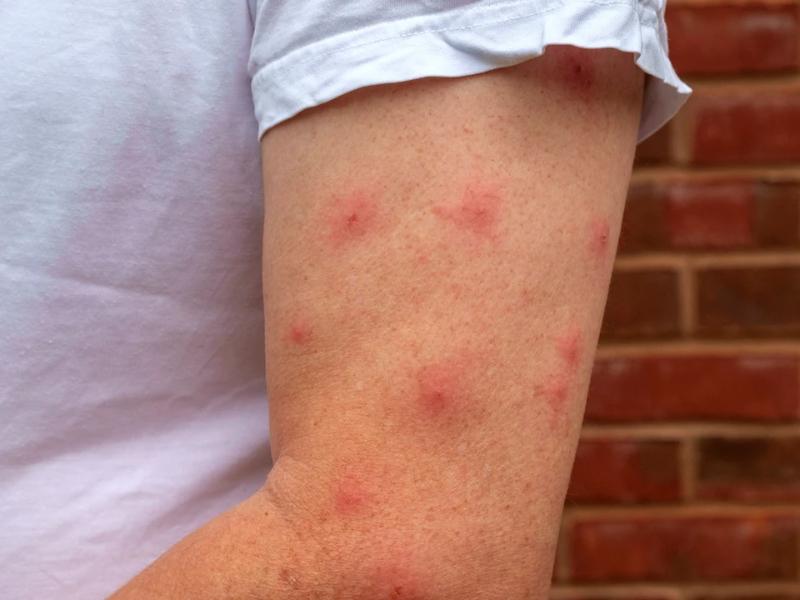 Médicos alertan por complicaciones del dengue en pacientes con enfermedades crónicas