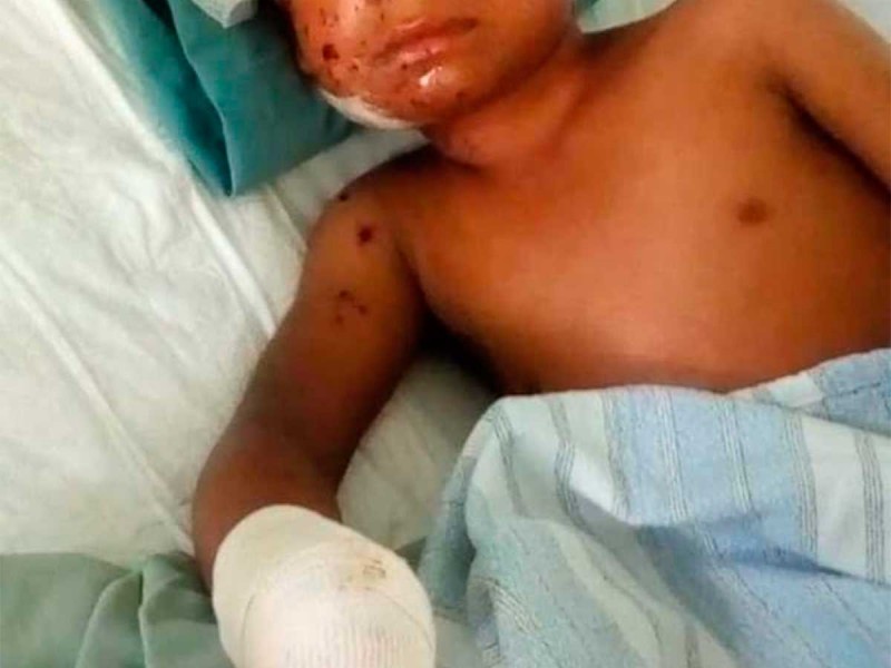 Niño de Oaxaca pierde mano por jugar con cohetes
