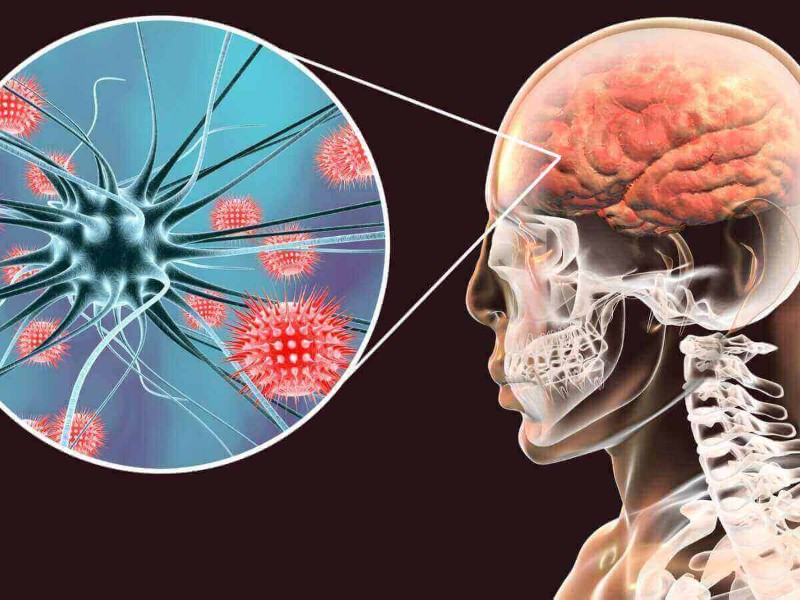 Nueva prueba detecta meningitis en solo una hora