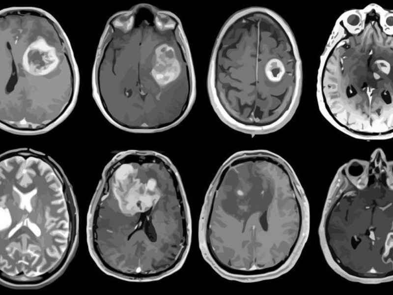 Ocho de cada 100,000 personas pueden tener un tumor cerebral