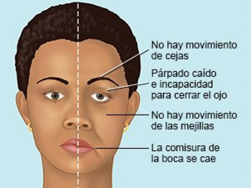 Parálisis facial, padecimiento asociaciado al estrés y mala alimentación