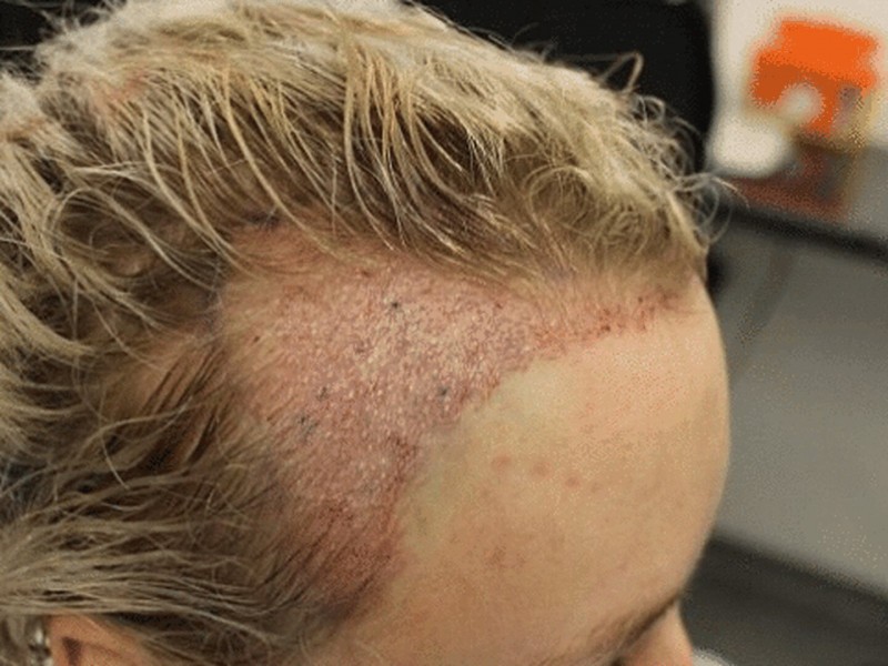 Peinados ajustados pueden provocar alopecia por tracción