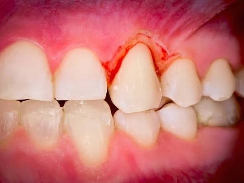 Periodontitis, primera causa de pérdida de dientes