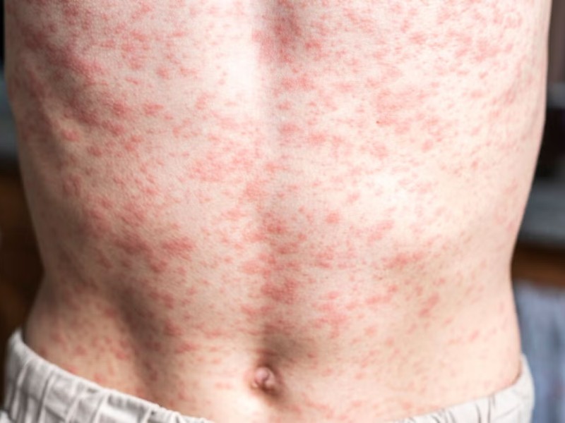 Persiste el brote de sarampión en México: OPS