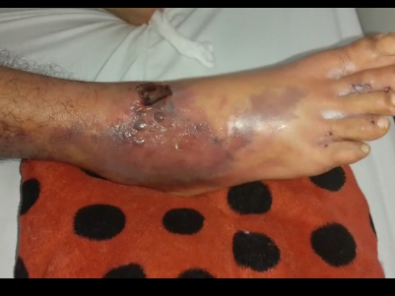 Picado por araña violinista sale del hospital