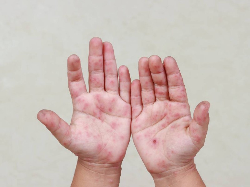 Piden  intensificar medidas sanitarias con menores de 5 años