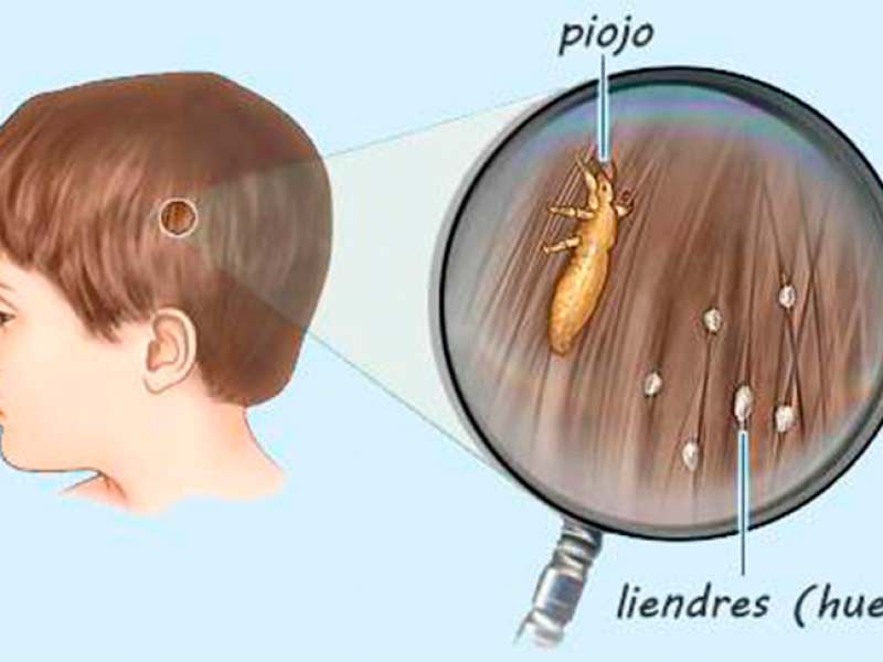 Previenen instituciones educativas contagios de pediculosis