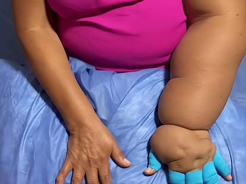 Programa Carril Rosa, ayuda a mujeres con linfedema en Xalapa