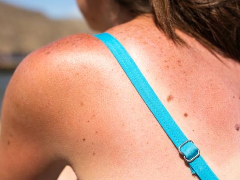 Radiación solar; un peligro para la piel