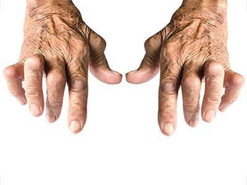 Realizarán Jornada gratuita para pacientes con artritis