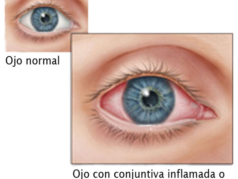 Recomendaciones para prevenir conjuntivitis