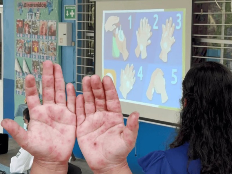 Refuerza SSO acciones preventivas ante casos de virus Coxsackie Refuerza SSO acciones preventivas ante casos de virus Coxsackie