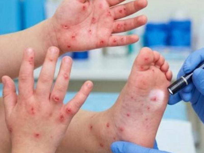 Reportan 209 casos de Coxsackie en Zacatecas; suman 30 brotes en 2026