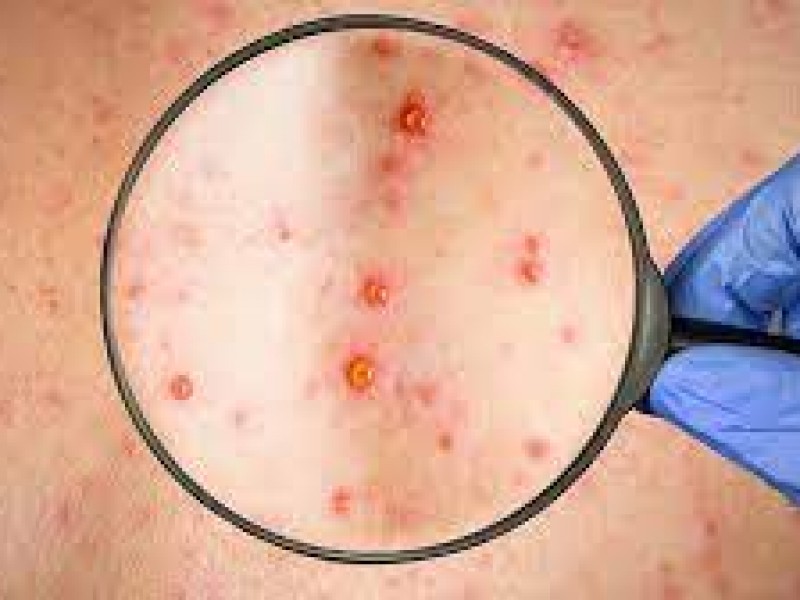 Reportan 6 nuevos casos de viruela símica