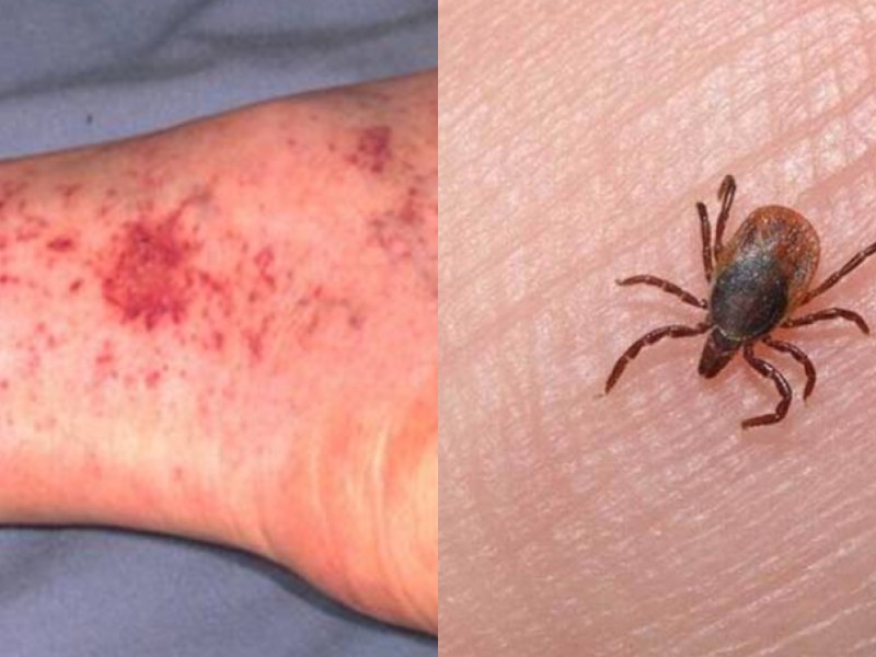 Rickettsia, enfermedad transmitida por las garrapatas