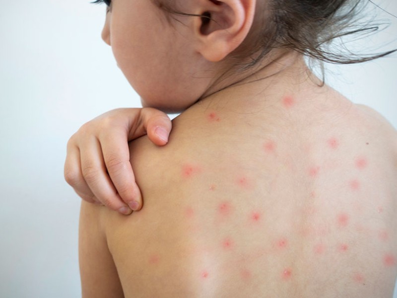 Salud confirma descenso de contagios y avance nacional en control del sarampión