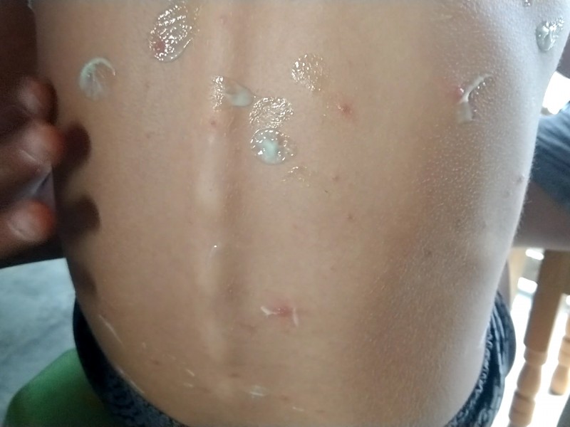 Salud descarta brote de varicela en primaria Netzahualcóyotl
