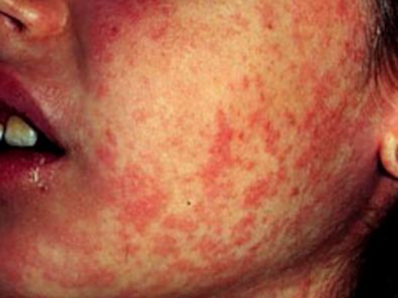 Sarampión: Más contagiosa que la influenza y el COVID