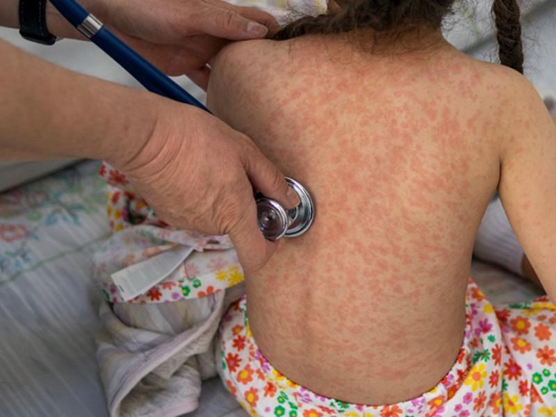 Sarampión mantiene brote activo en Zacatecas pese a disminución de contagios recientes