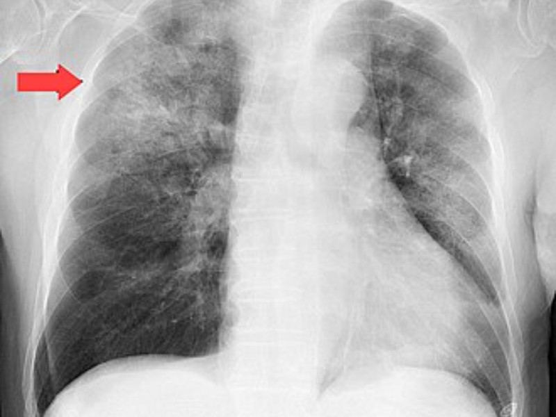 Se registran más de 2 millones de muertes al año por neumonía