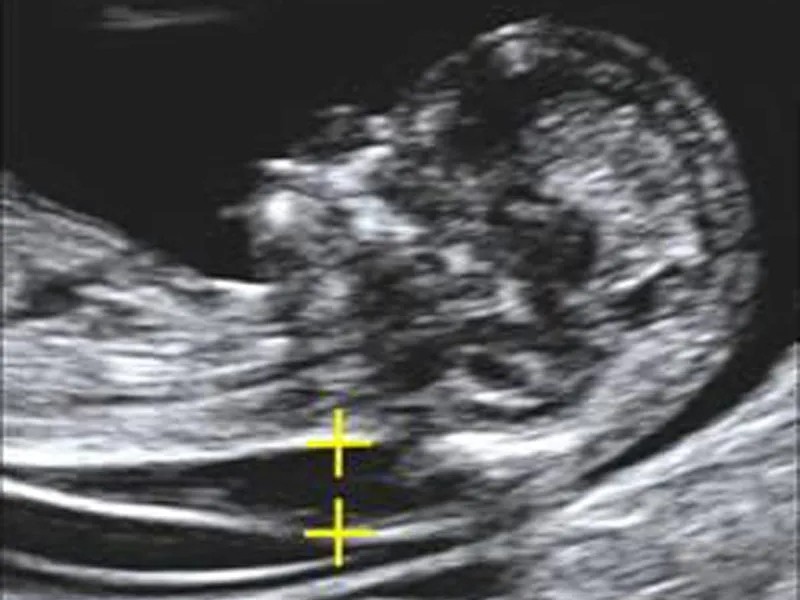 Síndrome de Down prenatal: avances médicos