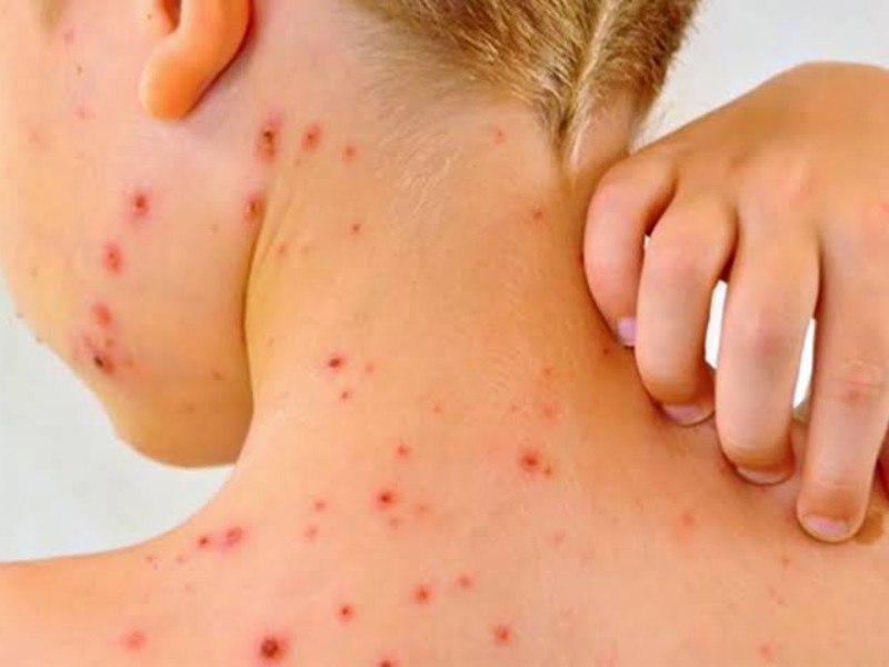 Suman 205 casos de sarampión en Jalisco