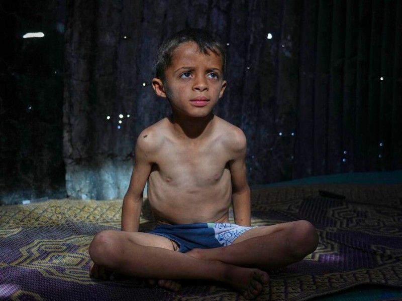 Un tercio de niños en Gaza sufren desnutrición severa