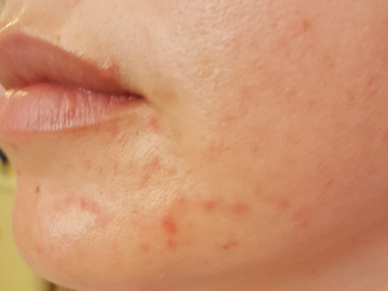 Uso de cubrebocas puede causar acné y dermatitis.