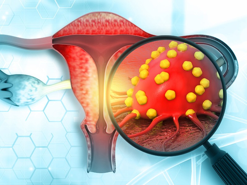 Van 15 defunciones por cáncer cervicouterino en La Laguna