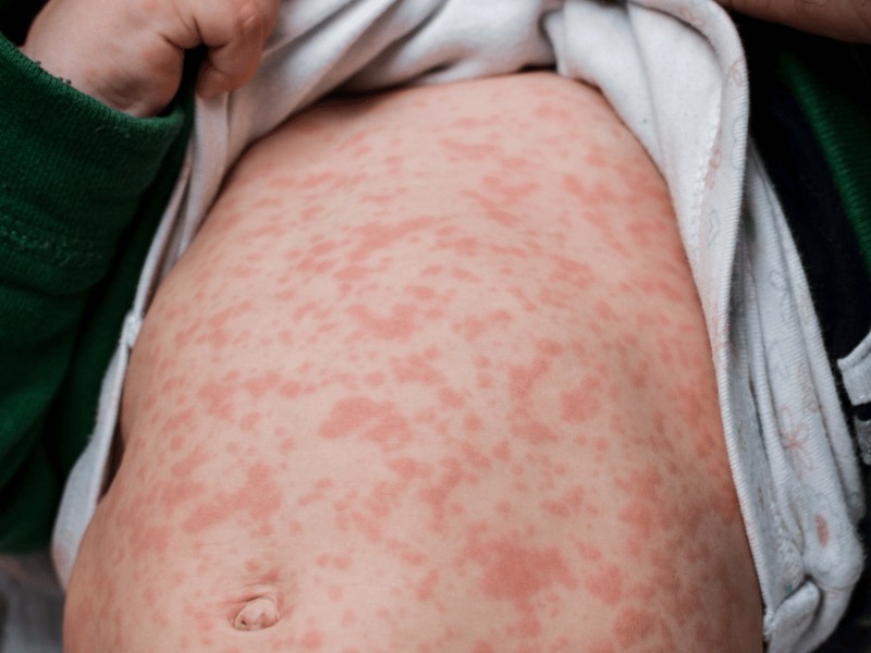 Van 2 mil 400 casos de sarampión en México